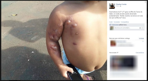 Criança mais nova tinha queimaduras pelo corpo, em Oiapoque (Foto: Reprodução/Facebook)