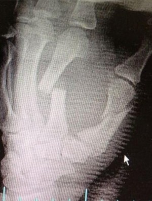 Mão quebrada Kevin Souza UFC MMA (Foto: Reprodução/Twitter)