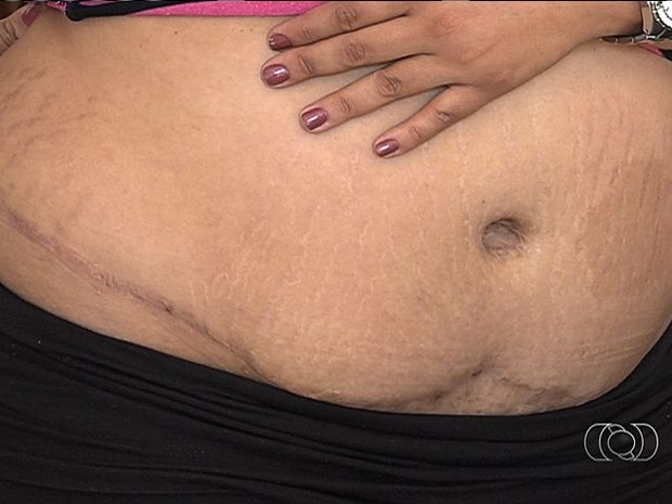 Jovem mostra deformação na barriga e no umbigo em Goiânia, Goiás (Foto: Reprodução/ TV Anhanguera)