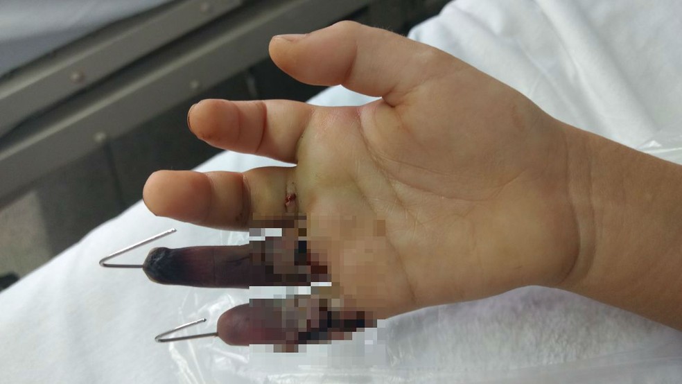 Mesmo após cirurgia, dedo anelar deverá ser amputado nesta sexta-feira (19) (Foto: Arquivo Pessoal)