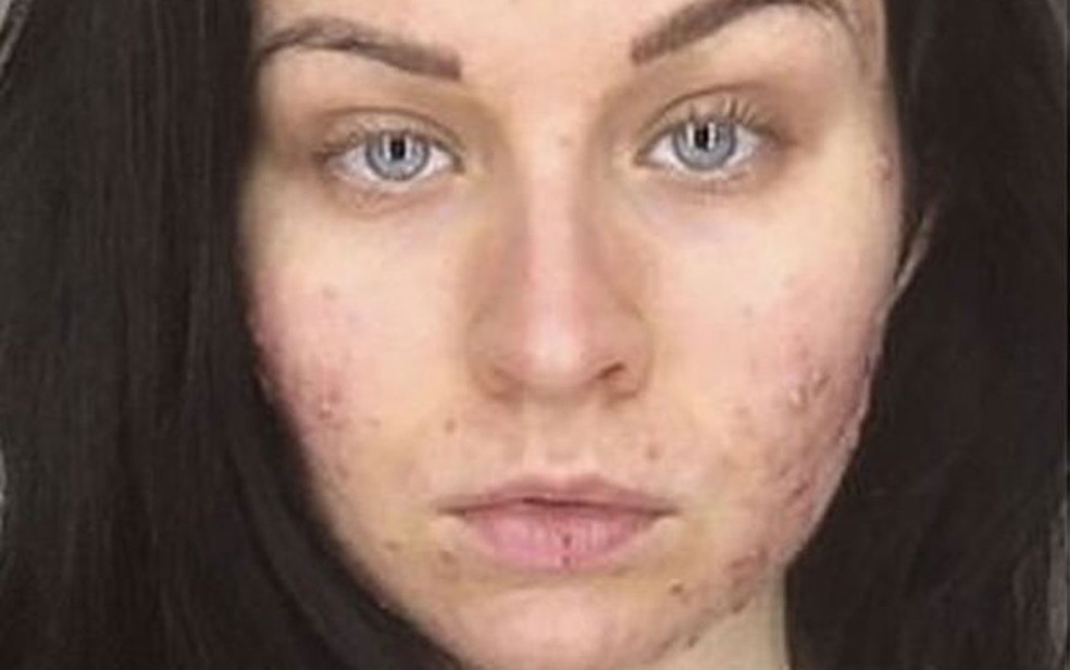 Pele e olhos mais secos é um dos efeitos do medicamento indicado para casos grave de acne (Foto: Judith Donald)