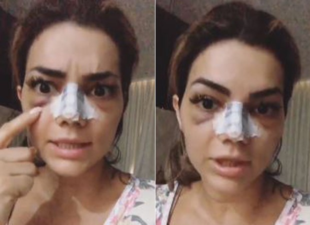 Kelly Key mostra hematomas após rinoplastia (Foto: Reprodução/Instagram) Kelly Key mostra hematomas após rinoplastia (Foto: Reprodução/Instagram)