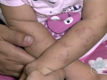 Criança de um ano e dez meses é mordida cerca de 50 vezes em escola (Foto: Reprodução/TV Globo)