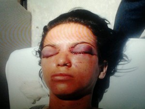 Mulher perde parte da visão após ter olhos perfurados por agressor, em Goiânia, Goiás (Foto: Arquivo pessoal)