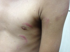 Marcas do ferimento ficaram no peito do menino (Foto: Marcelo Marques)