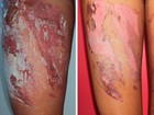 Cliente é queimada por
chapa de restautante (Hiale Silva/Arquivo Pessoal)