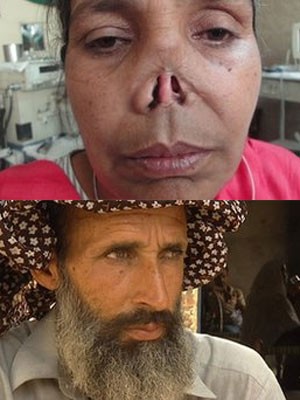 Mulher teve nariz cortado por marido e voltou a viver com ele anos depois (Foto: BBC)