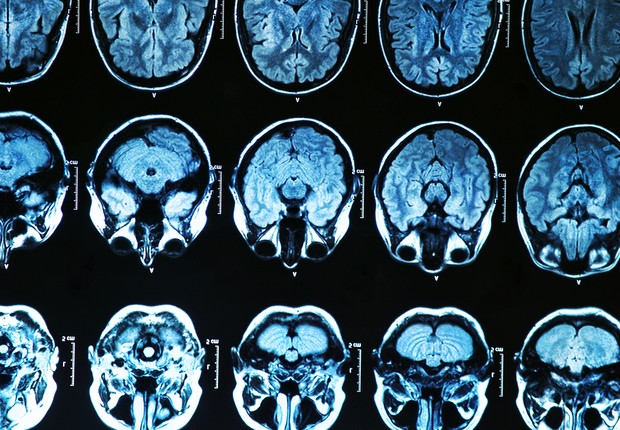 Tomografia do cérebro com contraste (Foto: Thinkstock)