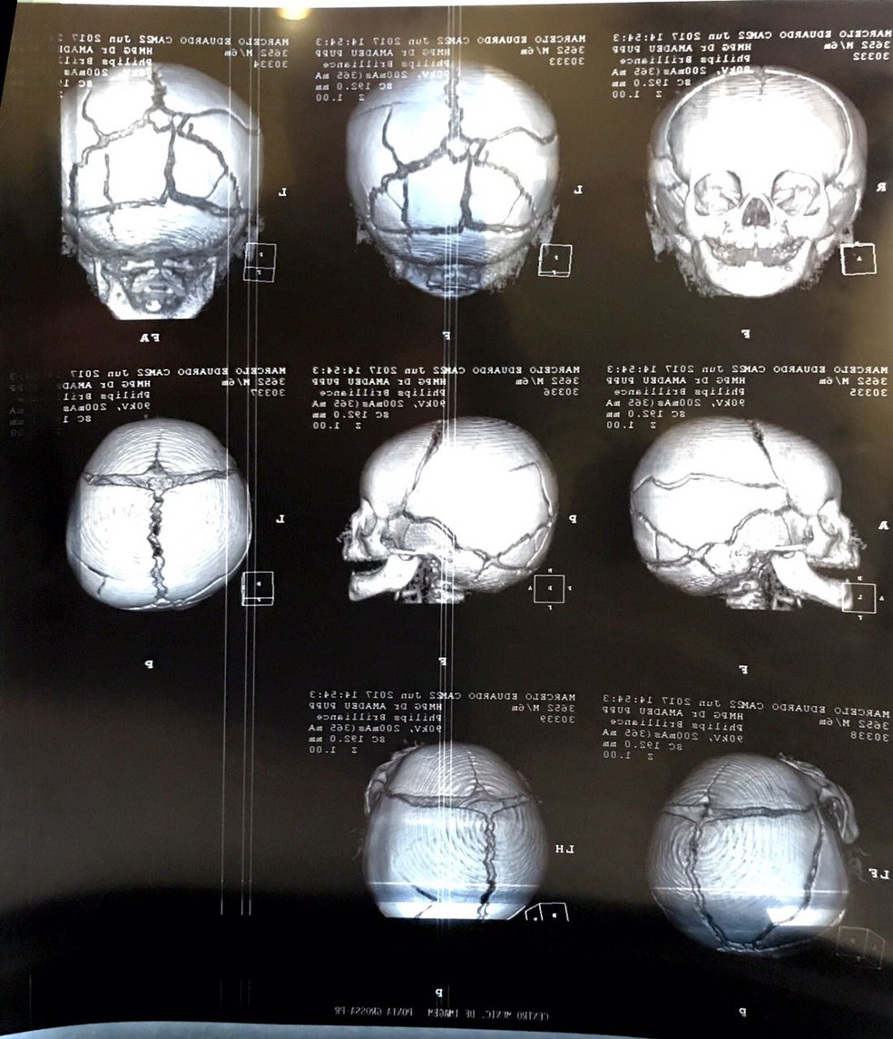  Bebê de seis meses foi internado com várias fraturas no crânio (Foto: Reprodução/RPC)
