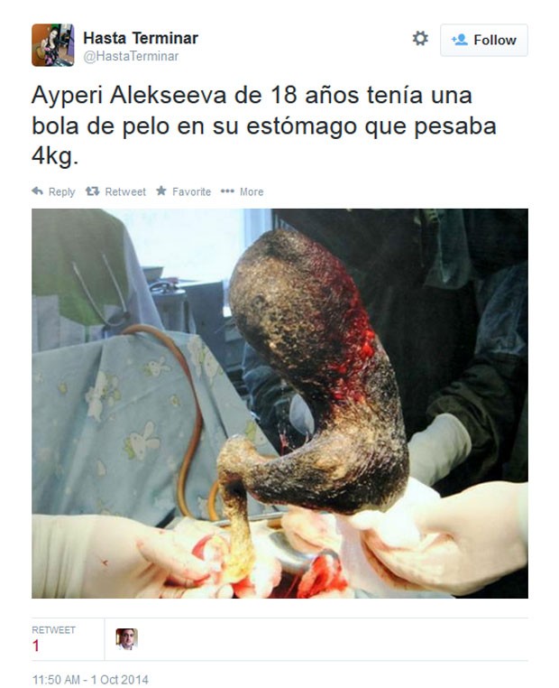 Médicos removeram bola de cabelos de quatro quilos do estômago de jjovem de 18 anos (Foto: Reprodução/Twitter/ Hasta Terminar)