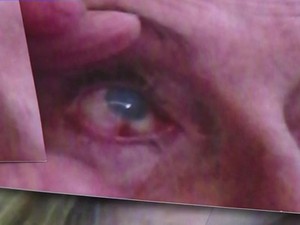 Aposentada mostra problema que surgiu em um dos olhos após cirurgia (Foto: Reprodução/RBS TV)