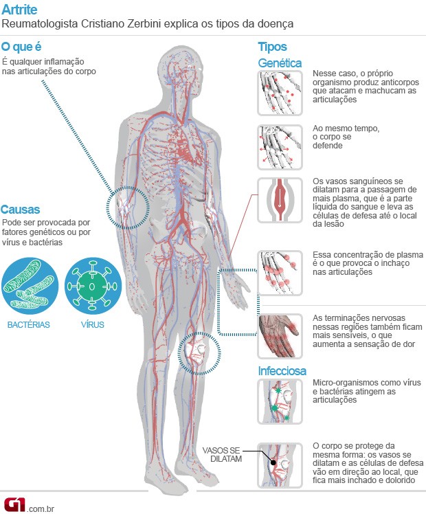 Artrite (Foto: Arte/G1)