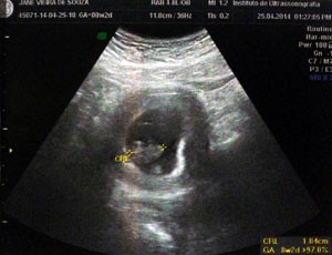 Imagem de ultrassonagrafia com data de 25 de abril deste ano  (Foto: Arquivo Pessoal/Facebook)