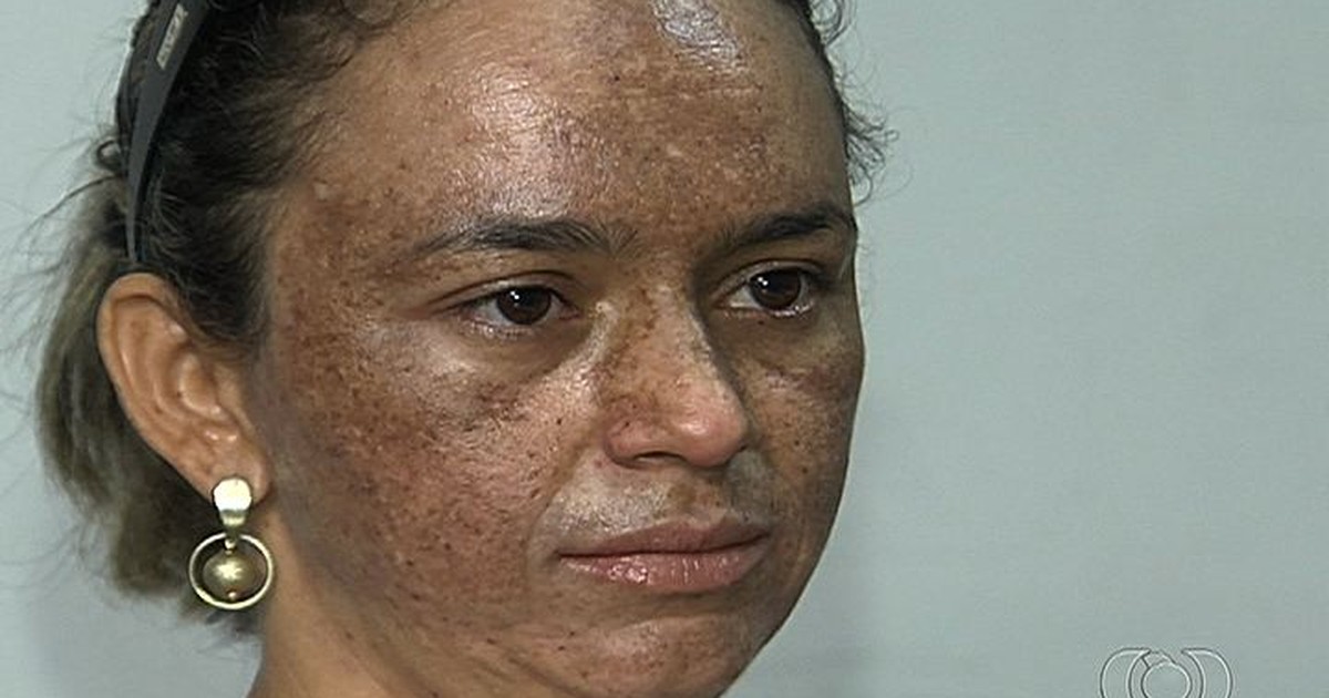 G1 - Mulher tem rosto queimado em tratamento e denuncia erro médico ...