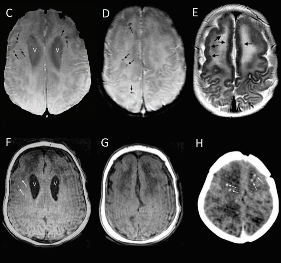 Imagens de ressônancia do cérebro de duas crianças avaliadas no estudo dos CDC (Foto: CDC/Divulgação)