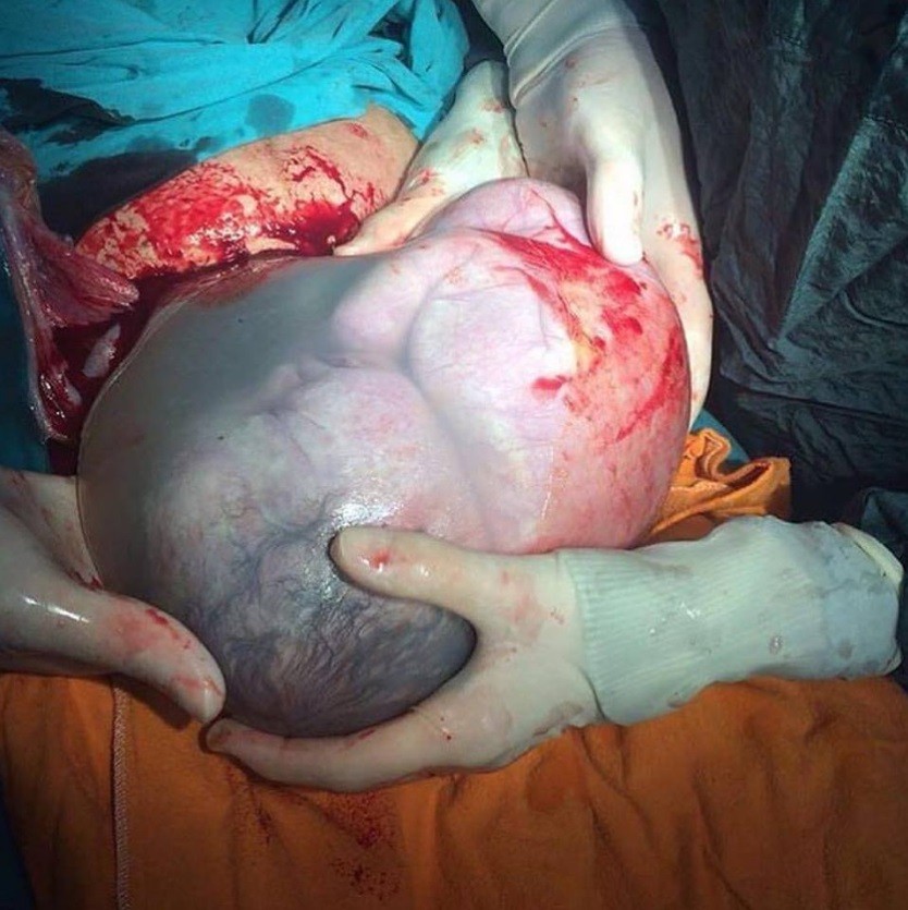 Bebê ainda envolto no saco amniótico