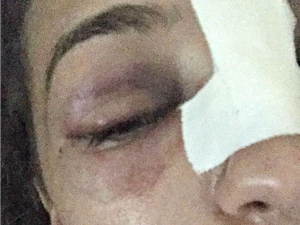 Enfermeira teve o nariz machucado durante confusão envolvendo lutador de MMA (Foto: Arquivo pessoal)