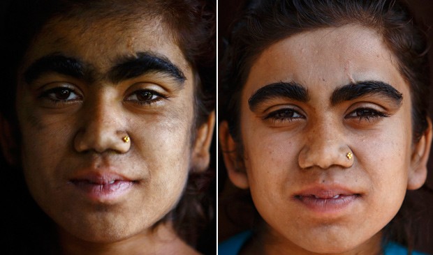 A garota Manjura Budhathoki, de 14 anos, é vista antes e depois do tratamento a laser. (Foto: Reuters/Navesh Chitrakar)
