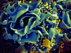 Remédio contra alcoolismo poderia eliminar vírus da aids, aponta estudo