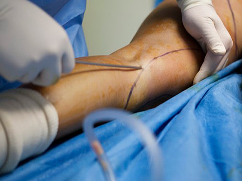 Lipoaspiração está entre as cirurgias estéticas mais realizadas no Brasil (Foto: Amelie Benoist/BSIP/Arquivo AFP)