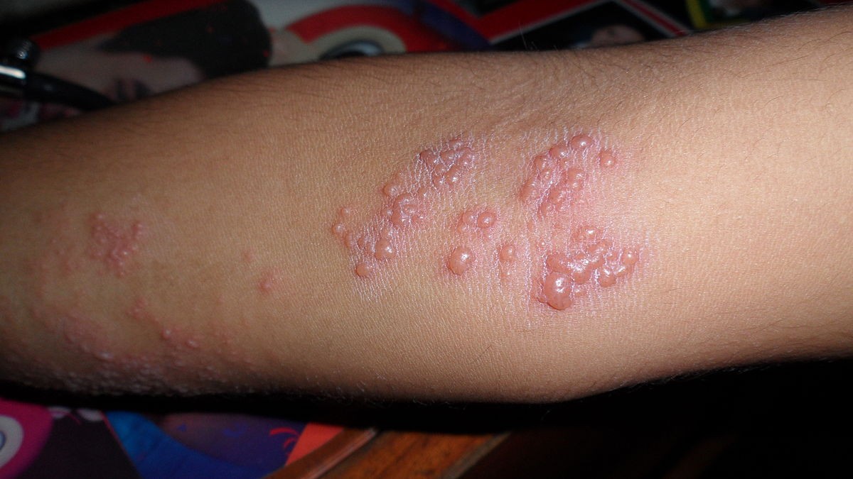 Exemplo de lesão causada por herpes no braço  (Foto: Wikimedia Commons )