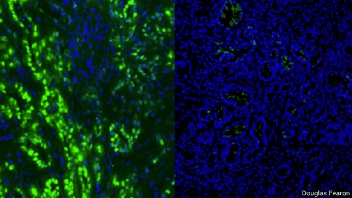 À esquerda, células de câncer no pâncreas aparecem em verde. Após o tratamento de seis dias (dir.), elas desapareceram (Foto: Douglas Fearon/BBC)