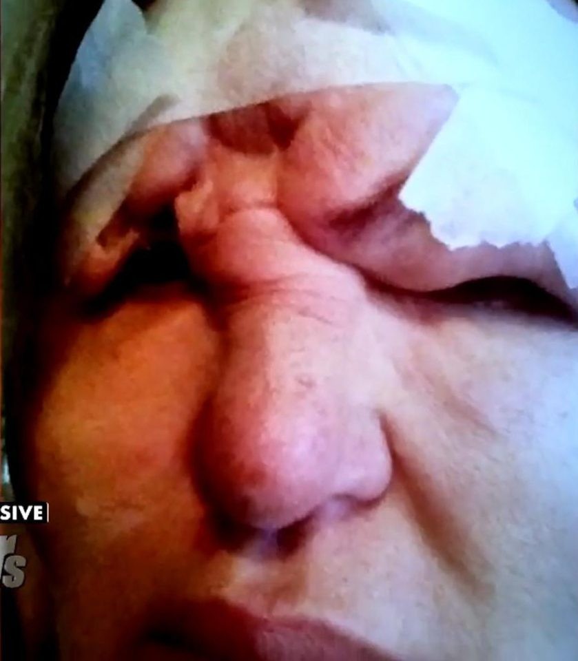 Os danos provocados por aplicação malfeita de preenchimento facial