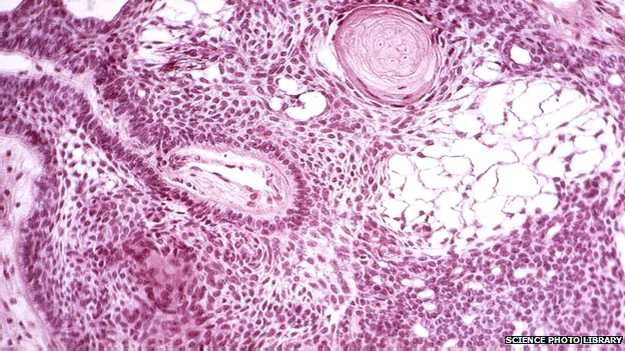 Células-tronco geneticamente modificadas podem produzir toxina que 'mata' tumores (Foto: Science Photo/Library)