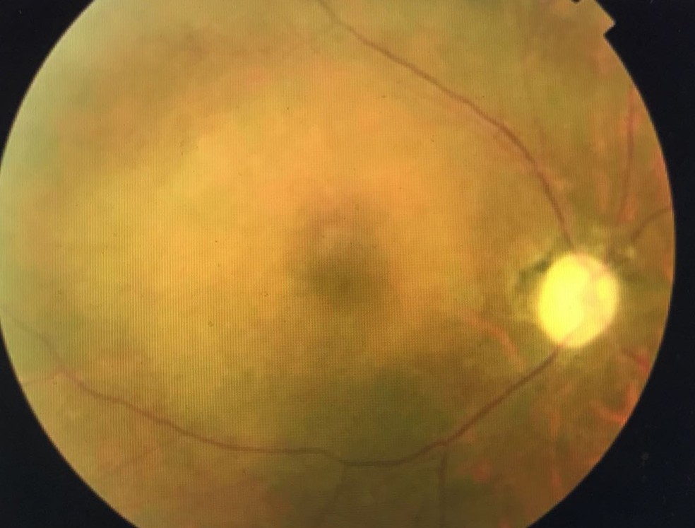 Exames oftalmológicos feitos em pacientes que tiveram chikungunya revelaram lesões de diferentes graus (Foto: Hermelino de Oliveira Neto/Divulgação)