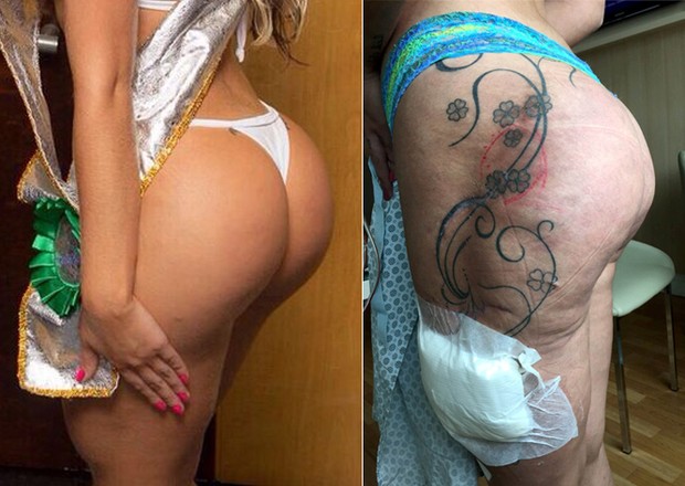 Andressa Urach - Bumbum antes e depois (Foto: Divulgação - Instagram / Reprodução)