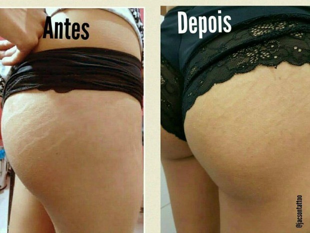 Tatuador Desenvolve Tecnica Em Cuiaba Para Camuflar Estrias Mato Grosso G1