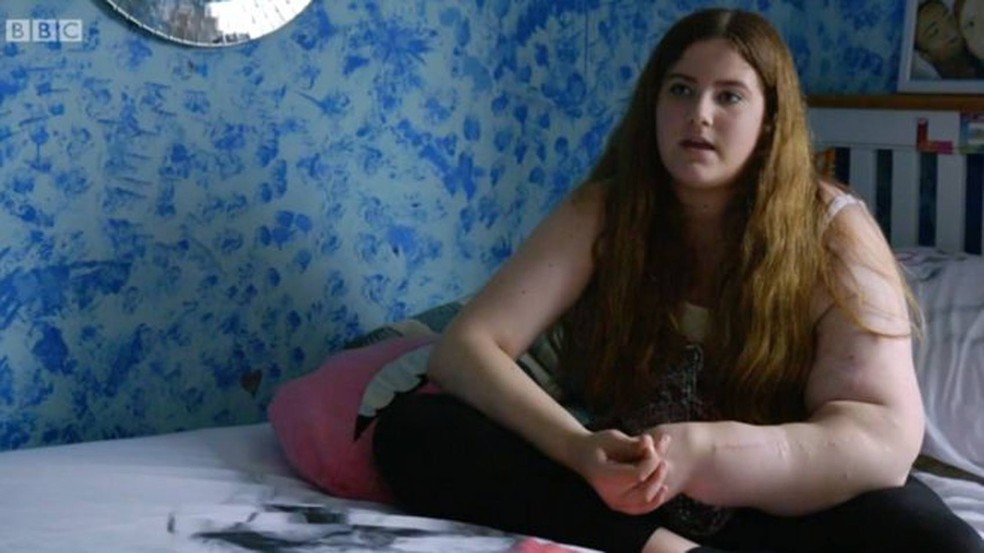 Leah já passou mais de 30 cirurgias para reduzir o tamanho do seu braço  (Foto: BBC)