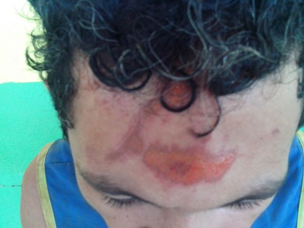 Suposto criminoso teve vários ferimentos no rosto (Foto: Guerard Castro/ Portal Guajará)