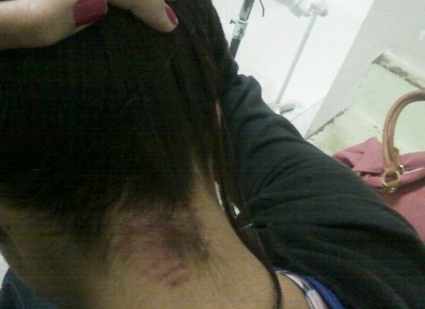 Adolescente agredida mostra um dos hematomas (Foto: Reprodução / TV Tem)
