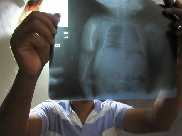 O pintor Cleginaldo Sousa mostra radiografia do filho; o bebê teve o braço fraturado durante o parto, em Brasília (Foto: Alexandre Bastos/G1)