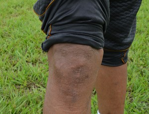 Alex Cardoso mostra marca da cirurgia no joelho (Foto: Matheus Henrique)