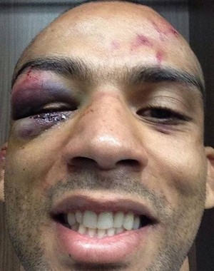 Edson Barboza não conseguia abrir o olho depois da luta (Foto: Reprodução Instagram)