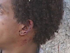 Orelha e pescoço também ficaram com ferimentos (Foto: Reprodução/TV TEM) Orelha e pescoço também ficaram com ferimentos (Foto: Reprodução/TV TEM)