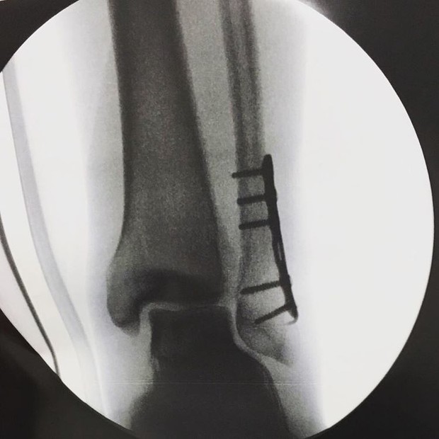 Fabio Assunção mostra raio-x (Foto: Instagram / Reprodução)