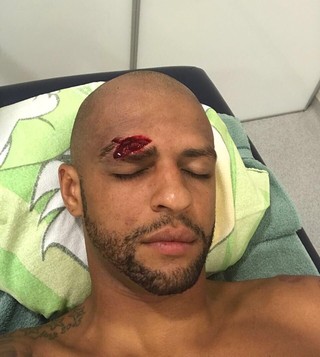 Felipe Melo Palmeiras corte supercílio (Foto: Reprodução/Twitter)
