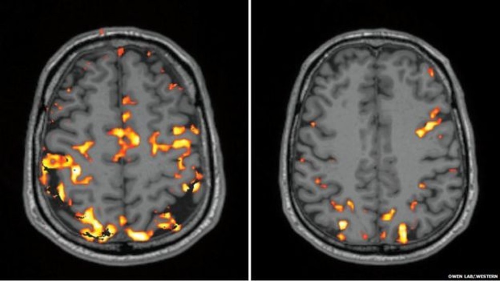 Imagem à esquerda mostra atividade do cérebro do repórter durante testes cognitivos depois de uma noite de sono normal, enquanto a da direita, do seu cérebro privado de sono (Foto: Owen Lab, Western )