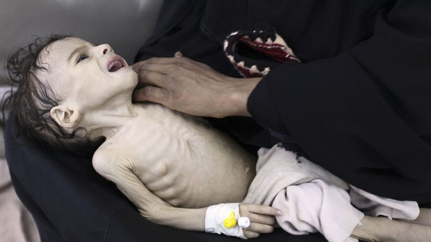 Mulher iemenita segura sua filha, com sérios problemas de subnutrição, no hospital al-Sabyeen, em Sanaa. (Foto: Mohamed al-Sayaghi/Reuters)