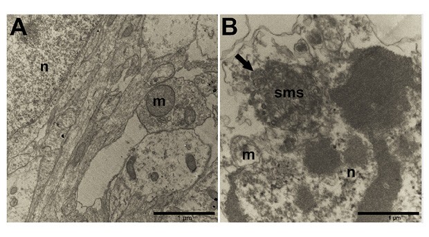 Tecido nervoso normal (A) e tecido infectado pelo zika (B); flecha mostra o vírus. (Foto: Rehen et. al/PeerJ)
