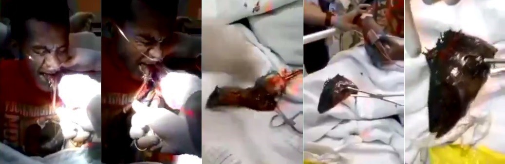 Detalhes da retirada do peixe
