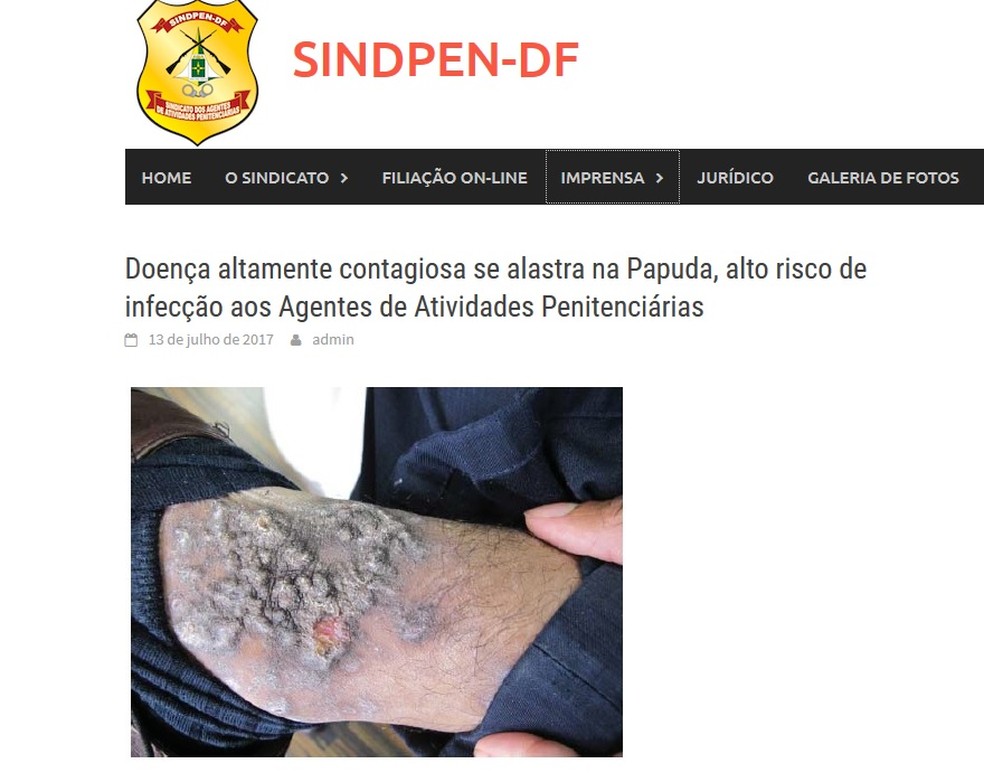 Foto do portal do Sindpen mostra doença de pele provocada por bactérias atingiu, ao menos, 600 detentos da Papuda, em Brasília (Foto: Sindicato dos Agentes Penitenciários/Reprodução)