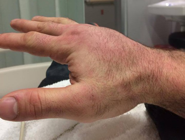 MMA Gabriel Napão mão quebrada (Foto: Reprodução/Facebook)