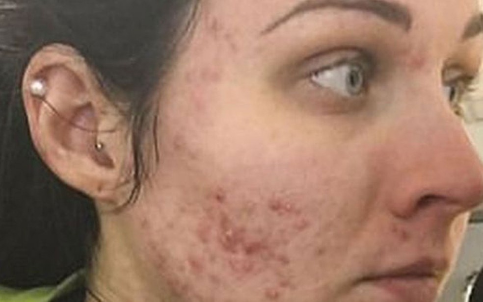Judith postou uma foto no Instagram antes de começar o tratamento com um medicamento controlado contra acne severa (Foto: Judith Donald)