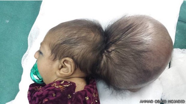 Criança no Afeganistão nasceu com um crânio colado à sua cabeça. (Foto: BBC)