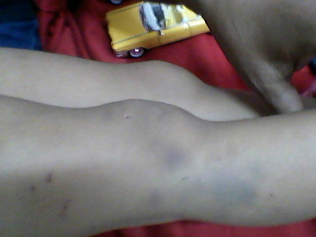 Marcas nas pernas da criança indicam as agressões (Foto: Divulgação/ Polícia Civil)