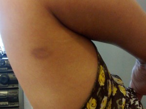 Marcas da agressão são vistas no braço da professora (Foto: Maiara Barbosa/ G1)